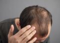 Novo Nordisk explora entrar en el mercado de la alopecia