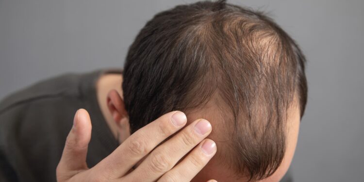 Novo Nordisk explora entrar en el mercado de la alopecia 1 Novo Nordisk explora entrar en el mercado de la alopecia